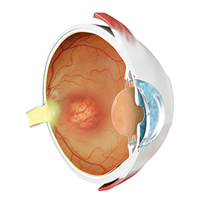 Age-Related Macular Degeneration