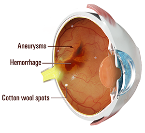 Diabetic Retinopathy