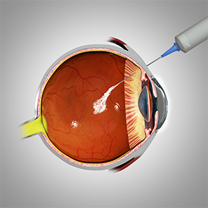 Intravitreal Injection for Macular Oedema