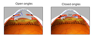 Open and Closed Iridocorneal Angles