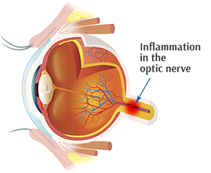 Optic Neuropathy