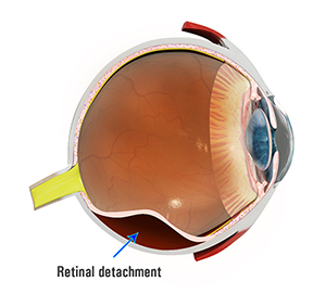 Retinal Tear