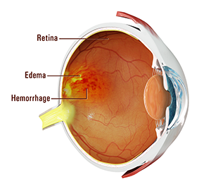 Retinal Vein Occlusion