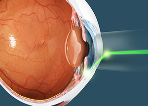 Selective Laser Trabeculoplasty