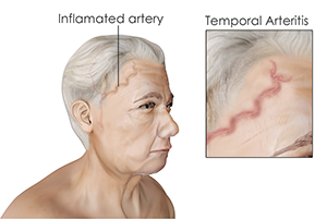 Temporal Arteritis