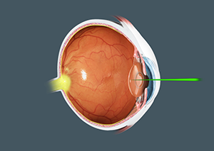 YAG Capsulotomy